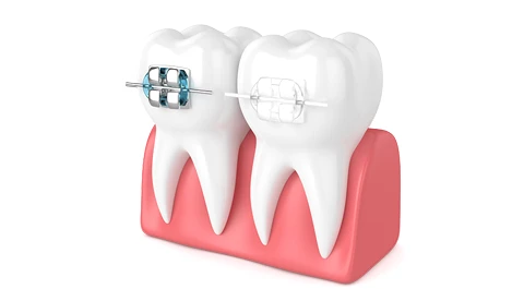 マウスピース矯正