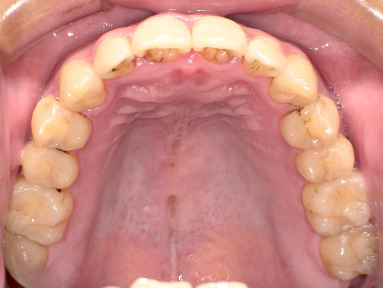 インビザラインの症例