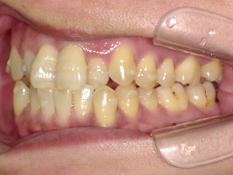 インビザラインの症例