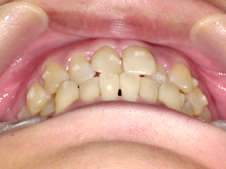 インビザラインの症例