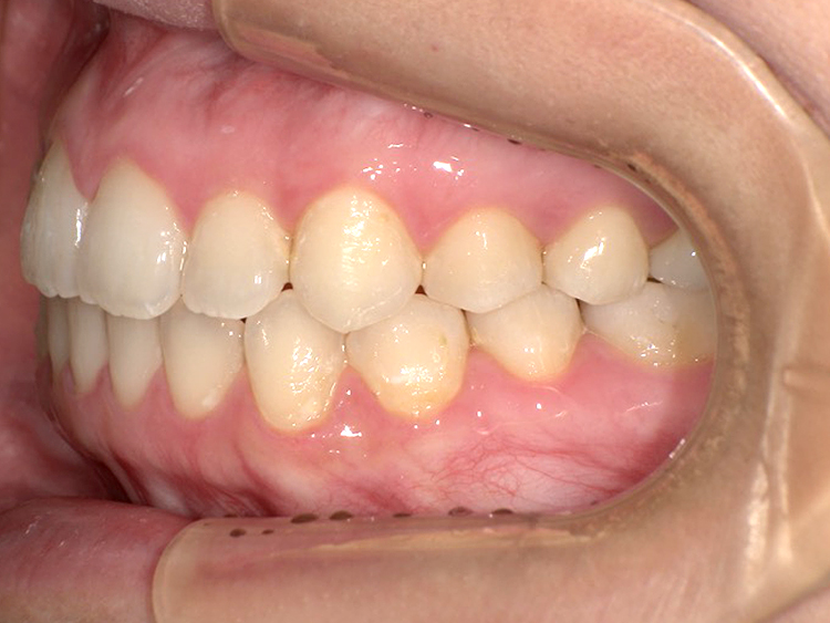 インビザラインの症例