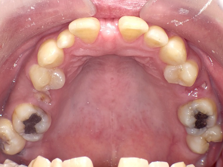 インビザラインの症例