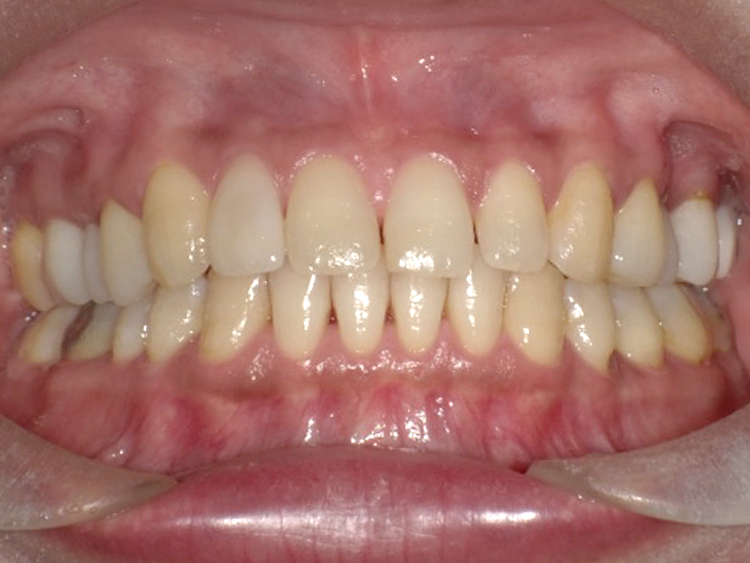 インビザラインの症例