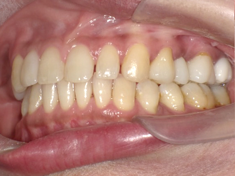 インビザラインの症例