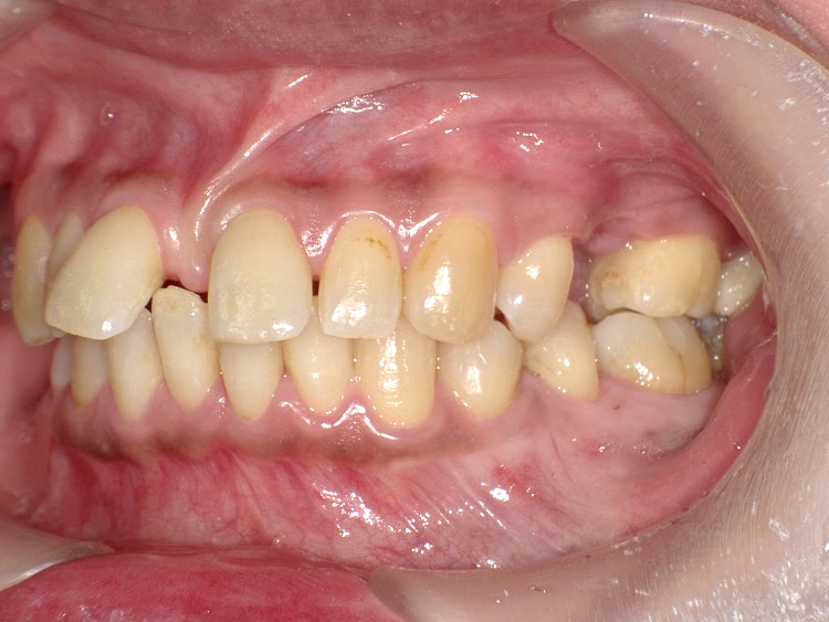 インビザラインの症例