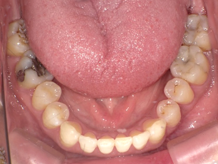 インビザラインの症例