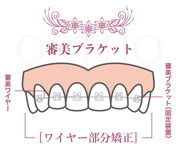 審美ブラケット