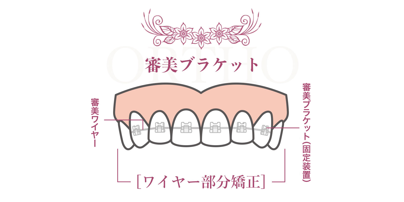 審美ブラケット