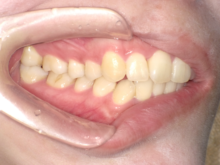 部分矯正の症例