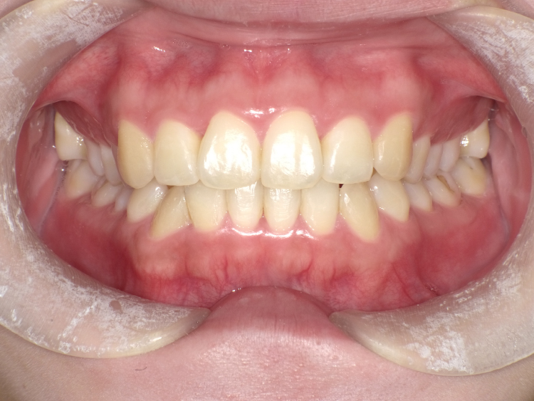 部分矯正の症例