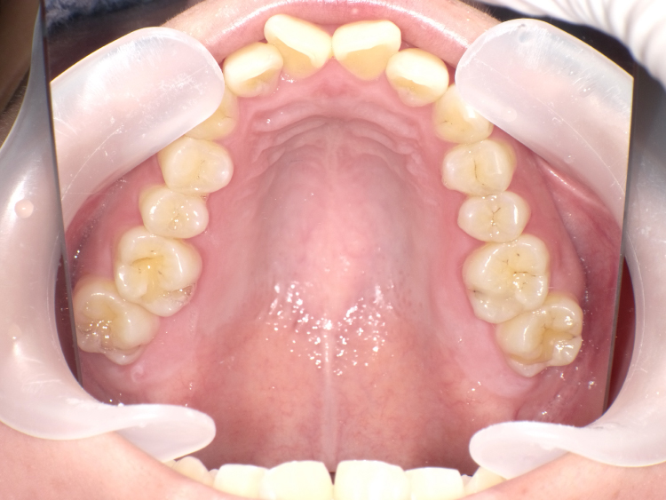 部分矯正の症例