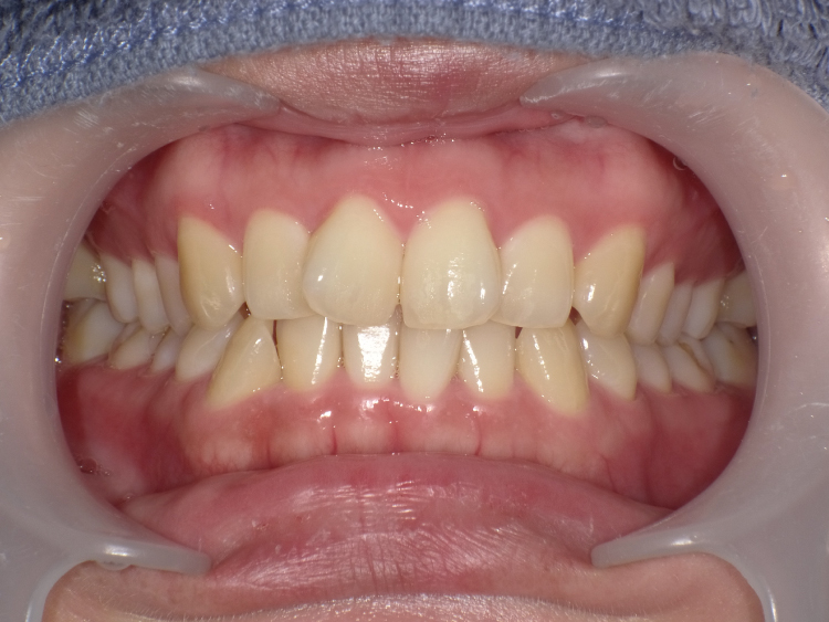 部分矯正の症例