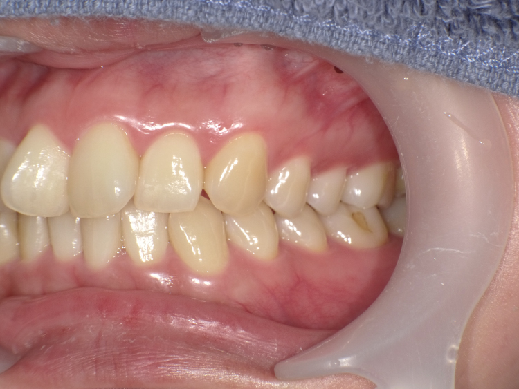 部分矯正の症例