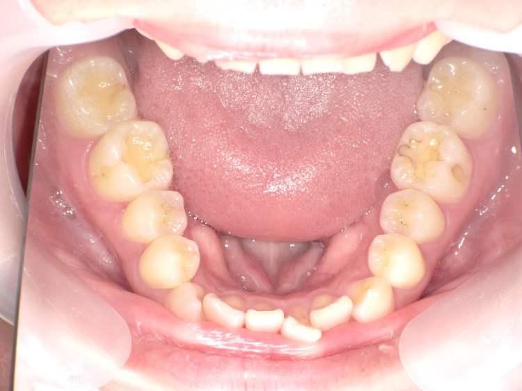 部分矯正の症例