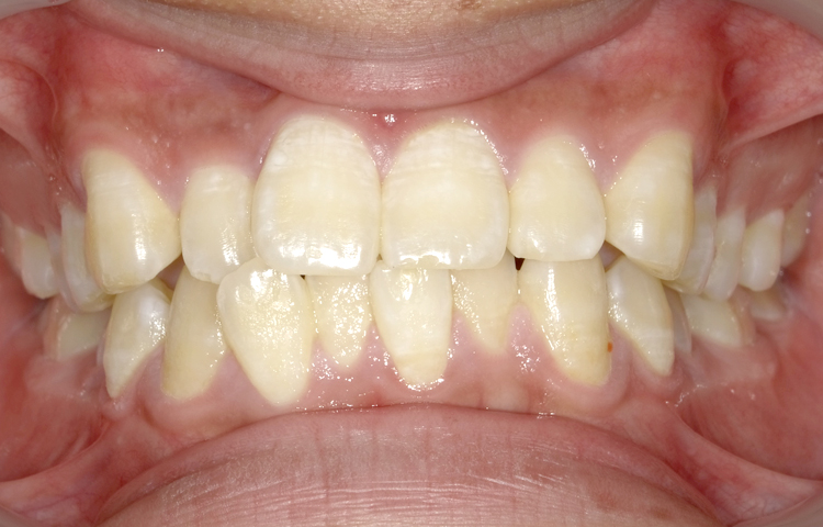 部分矯正の症例写真