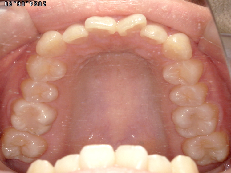 部分矯正の症例