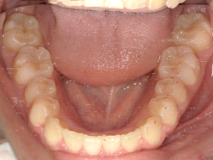 部分矯正の症例
