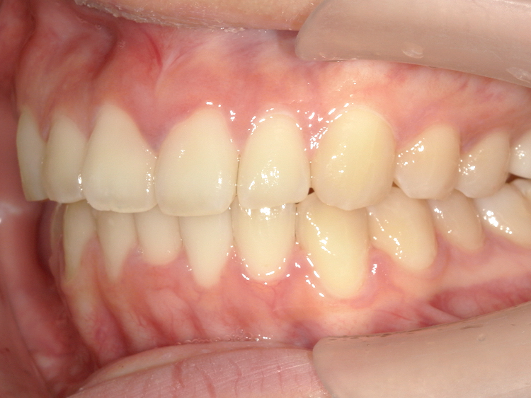 部分矯正の症例