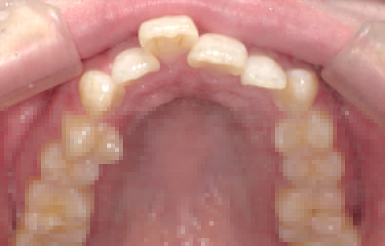 部分矯正の症例写真