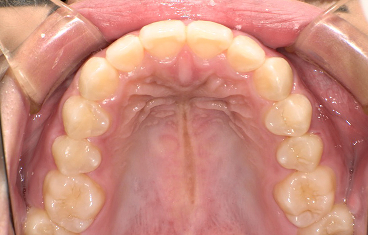 部分矯正の症例写真