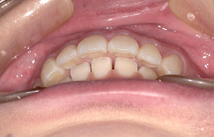 部分矯正の症例写真