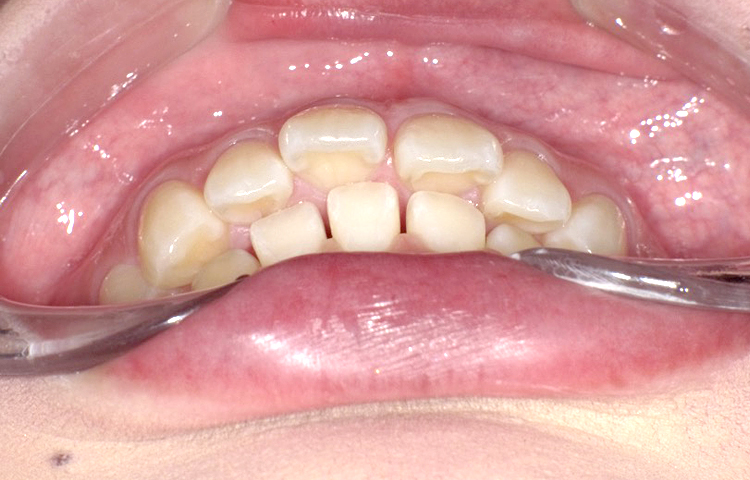 部分矯正の症例写真