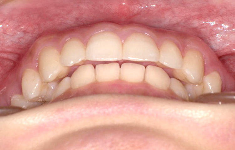 部分矯正の症例写真