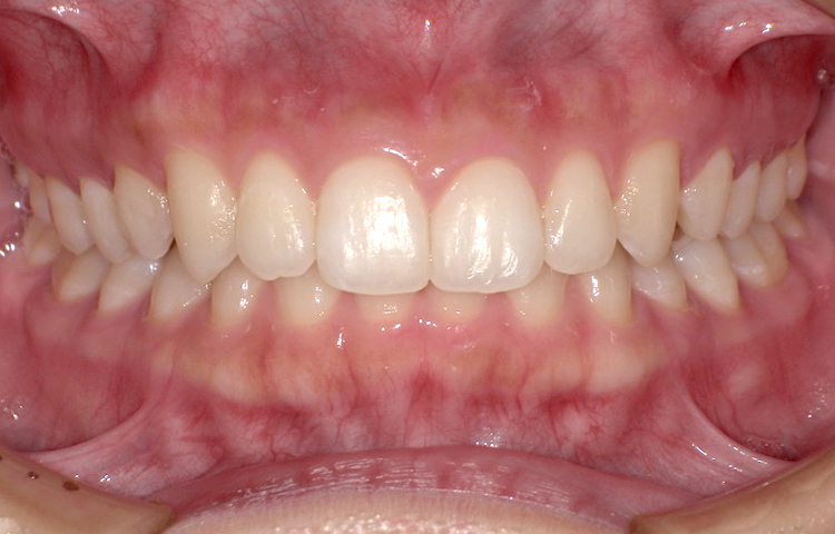 部分矯正の症例写真