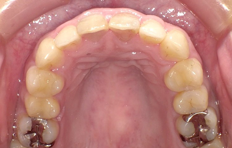 部分矯正の症例