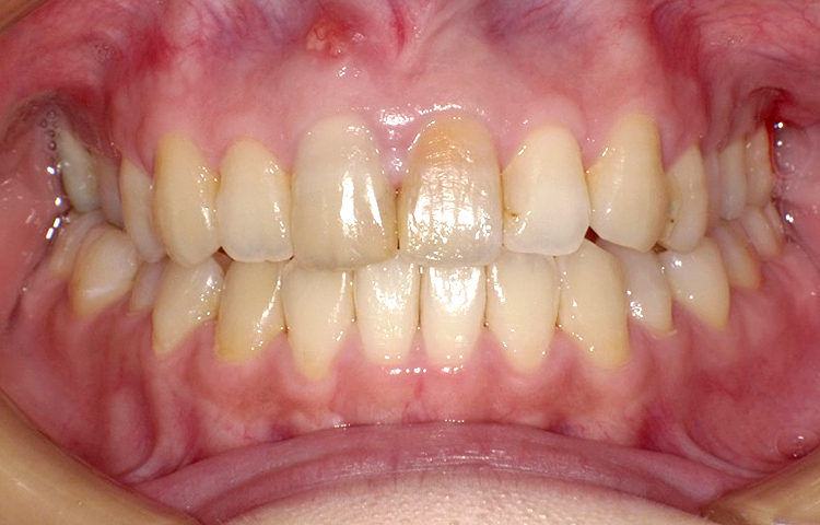 部分矯正の症例