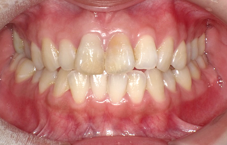 部分矯正の症例