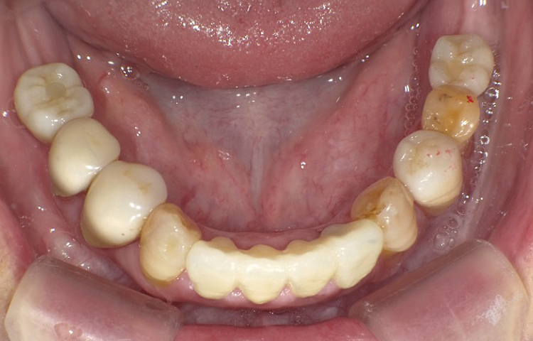 審美歯科の症例