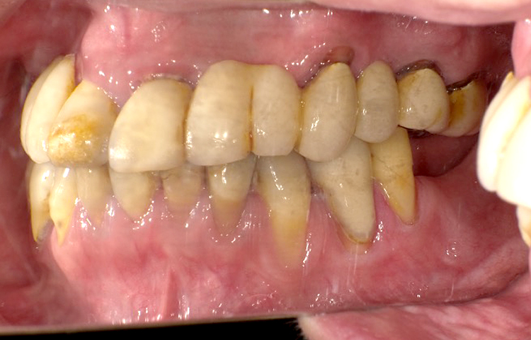 審美歯科の症例