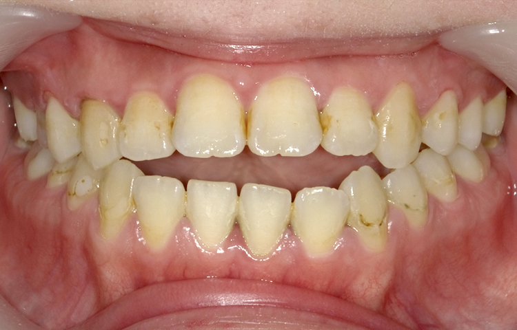 ホワイトニングの症例写真