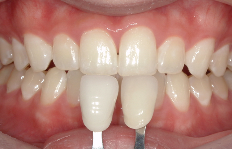ホワイトニングの症例写真