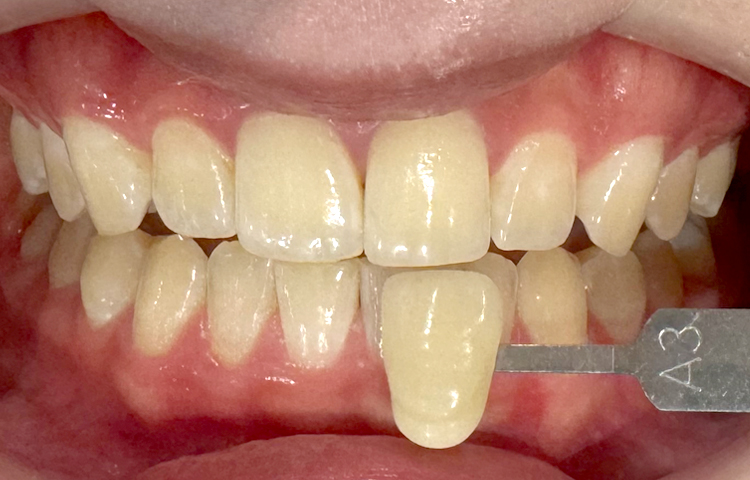 ホワイトニングの症例写真